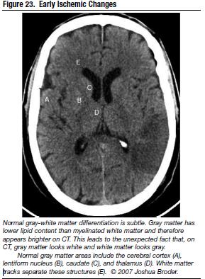table 2 stroke conversion Stroke For (MRI) Magnetic Imaging Resonance Acute table 2 stroke conversion Stroke For (MRI) Magnetic Imaging Resonance Acute